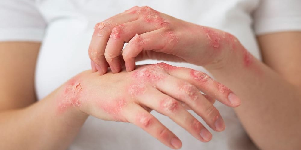 Understanding Fungal Infections and Skin Allergies from an Ayurvedic Perspective